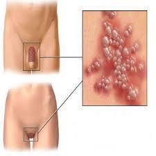 Οι σεξουαλικά μεταδιδόμενες μορφές του HPV επίσης προκαλούν καρκίνους, ένα μεγάλο ποσοστό των καρκίνων του πρωκτού οφείλεται σε αυτές τις μορφές HPV ενώ το 25% των καρκίνων του στόματος και του