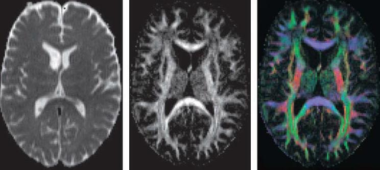 Μαγνητική δεσμιδογραφία (DTI ή tractography) Α.