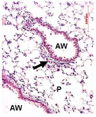 Φλεγμονή πνευμόνων (Score) Preparation for a first-in-man lentivirus trial in patients with cystic fibrosis Alton EWFW,