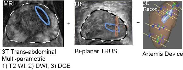 target biopsy (MRI-TB), (2) MRI-transrectal