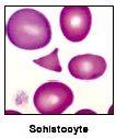 Μικροαγγειοπαθητική αιµολυτική αναιµία Μηχανικό τραύµα λόγω: Πρόσθετων βαλβίδων Στένωσης ή απόφραξης της κυκλοφορίας - Διάχυτη ενδαγγειακή πήξη -
