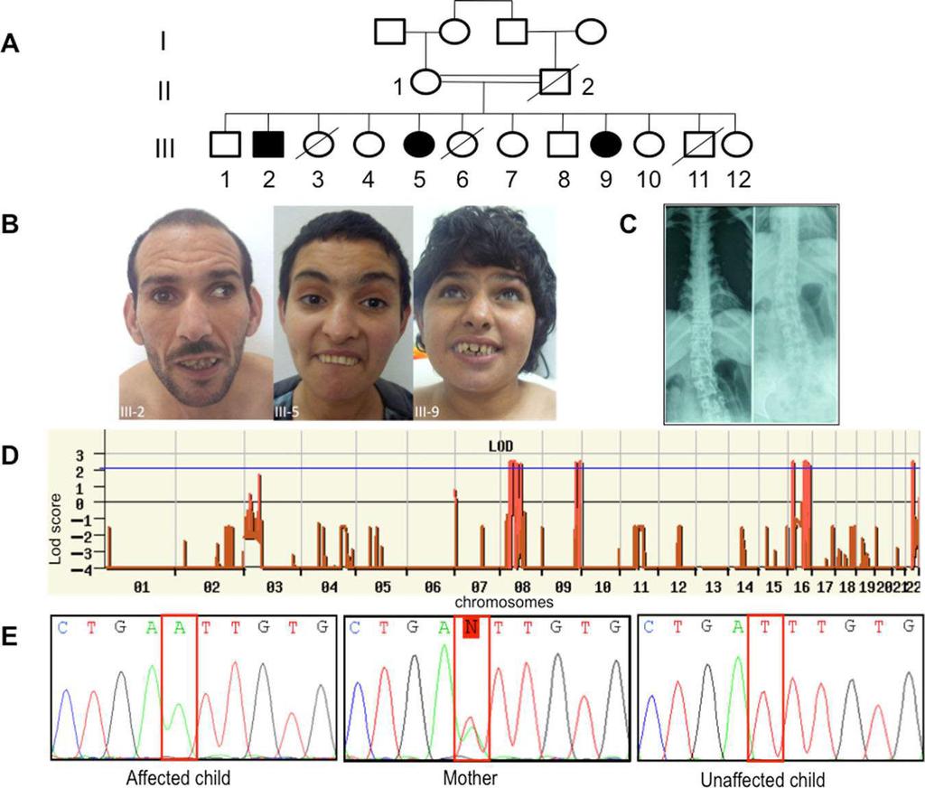 Figure 1. A missense mutation in TTI2 underlies a novel form of autosomal recessive syndromic ID. A: Pedigree of the family. Shaded symbols indicate the affected individuals.