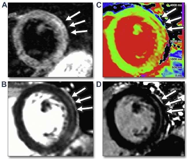 T1-Mapping for the Diagnosis of Acute Myocarditis using CMR Comparison of T2-Weighted and