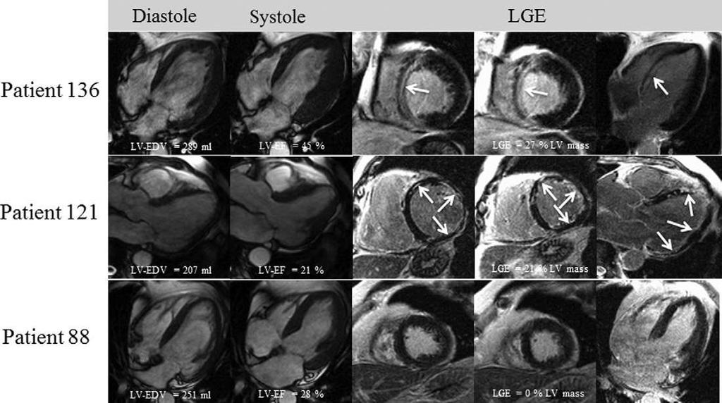 The Combined Incremental Prognostic Value of LVEF, Late Gadolinium Enhancement, and Global