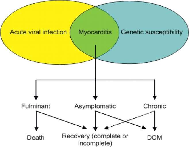 Evolution of Acute Viral Myocarditis R