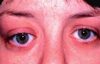 (Ε) Στεφανιαία τομή ΑΤ που δείχνει μία βλάβη του κογχικού λοβού. (Ευγενική παραχώρηση από J Harry and G Misson, από Clinical Ophthalmic Pathology, utterworth-heinemann 2001 Εικόνα.