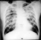 Περιοριστικές διαταραχές των πνευμόνων: