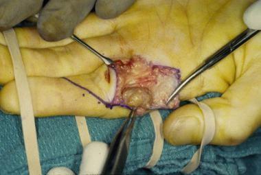 Γιγαντοκυτταρικός όγκος τενοντίων ελύτρων (Giant-cell tumor of tendon sheath) μεμονωμένος όγκος των τενόντων της άκρας χειρός Ηλικία 30-50 ετών.