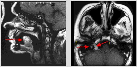 ΜΕΤΑΣΤΑΣΗ ΚΑΤΑ ΑΛΜΑΤΑ SKIP METASTASES Περιγράφηκε από τον Smith JA 1977 υπερπήδηση λεμφογαγγλίων ή μετάσταση κατά άλματα, (απευθείας προσβολή χαμηλότερων επιπέδων τραχηλικών