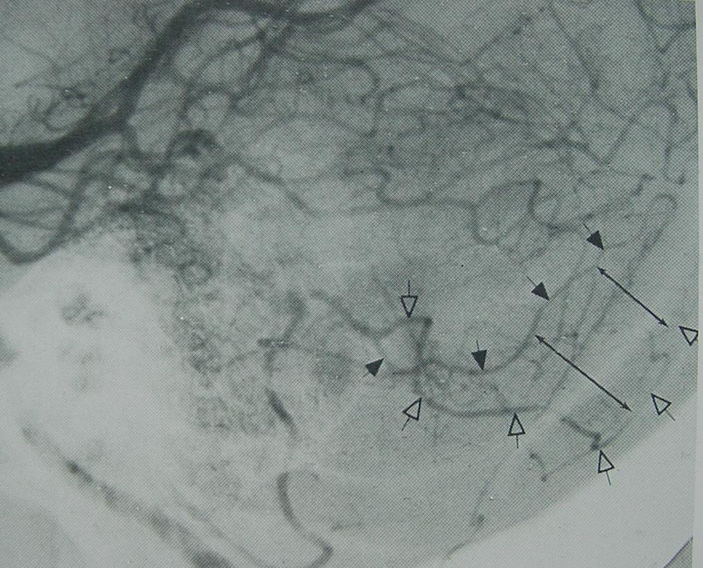 DISTAL