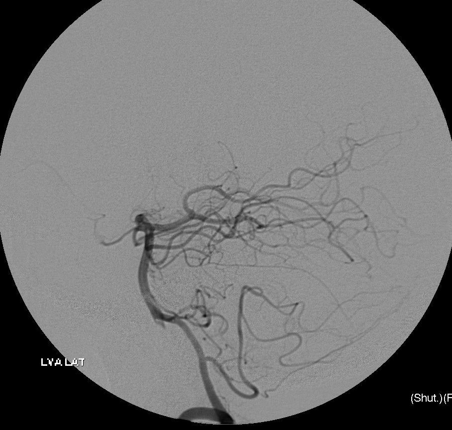 Meningeal