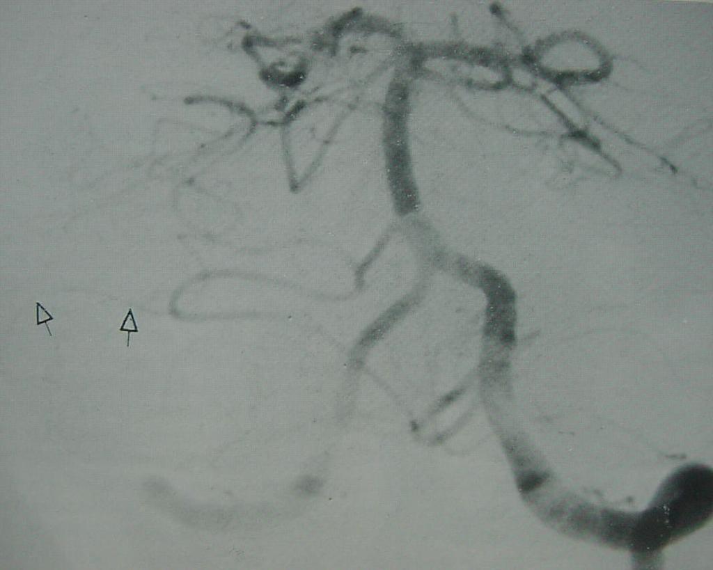 LATERAL branch AICA