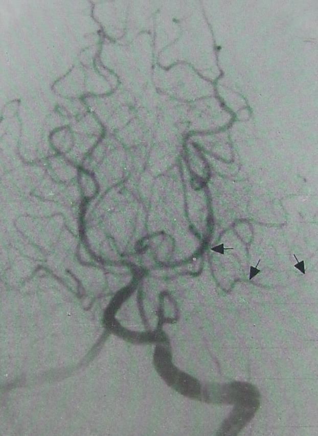 MARGINAL branch