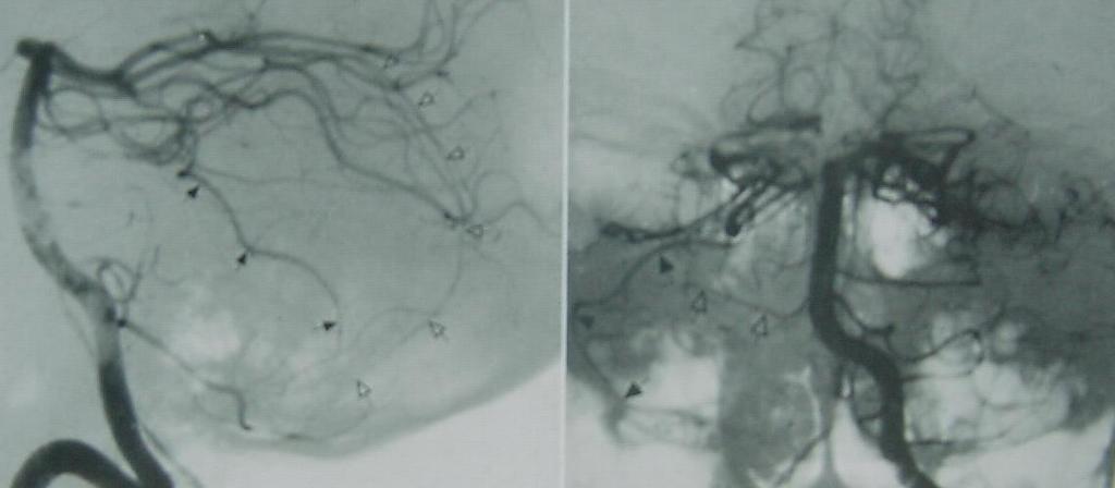 Marginal Vermis anastomosis LARGE MARGINAL