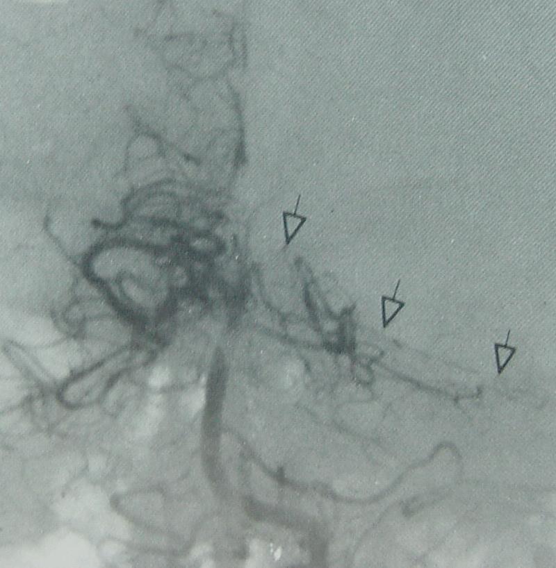 Absent L PCA