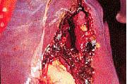 C Κυκλοφορία & όγκος αίματος Ενδοπεριτοναϊκή αιμορραγία -Διάγνωση : κλινική εξέταση σε