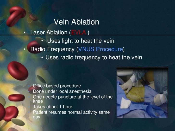 ΕΝΔΑΓΓΕΙΑΚΟΣ ΚΑΥΤΗΡΙΑΣΜΟΣ ENDOVENOUS ABLATION Θερµοκαυτηριασµός µε Laser Θερµοκαυτηριασµός µε ραδιοσυχνότητες Χηµικός καυτηριασµός (σκληροθεραπεία) Μπορεί να γίνει