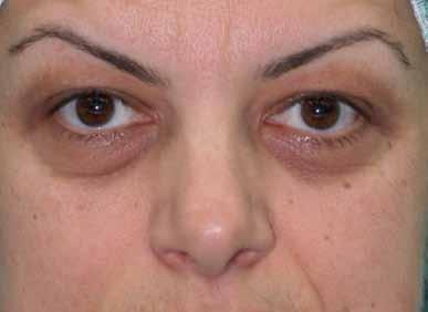 οφθαλμοπλαστική Δερματοχάλαση άνω βλεφάρων. 3 εβδομάδες πριν την επέμβαση έγινε Botox για να ανέβει και το φρύδι, ώστε να γίνει πιο ακριβής υπολογισμός του δέρματος που θα αφαιρεθεί.