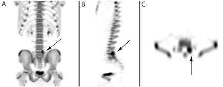 radiographs are negative most sensitive (however lesion may be