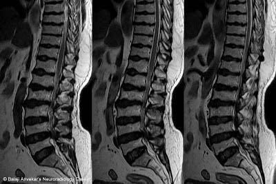 wedging, antero posterior elongation,