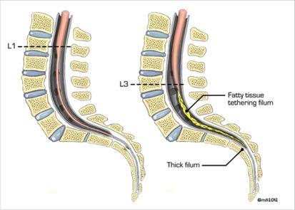 Σύνδρομο προσδεμένου μυελού Οσφυαλγία με