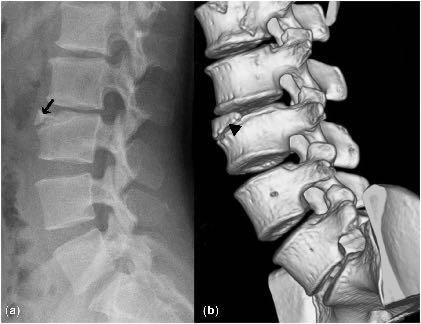 limbus vertebra πρόπτωση τμήματος του