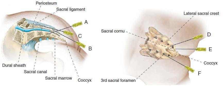 Figure 42-11. Sites of misplacement of local anesthetic for caudal block anesthesia.