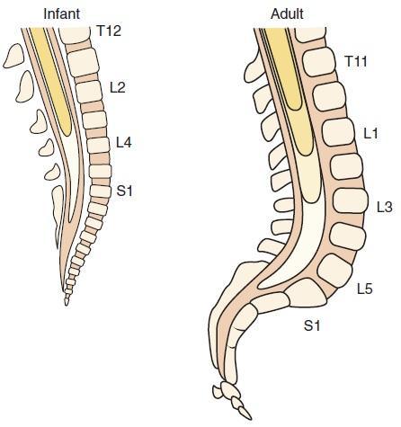 Figure 42-4. Anatomic differences between adults and children that affect the performance of spinal and epidural anesthesia; an infant s sacrum (left) is flatter and narrower than an adult s (right).