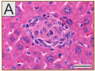 περιοχή του κοκκιώματος (Α) Πολλαπλά ηπατικά κοκκιώματα - 3 εβδομάδες μετά τη μόλυνση με Brucella melitensis (Χρώση αιματοξυλίνης -
