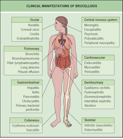 Κλινική εικόνα Βρουκέλλωση: συστηματική λοίμωξη με ποικίλες κλινικές εκδηλώσεις Προσβολή οποιουδήποτε συστήματος ή οργάνου του ανθρώπου Διαφορική διάγνωση πολλών κλινικών καταστάσεων Μη ειδικά