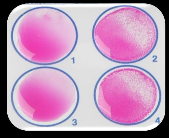 Ορολογική διάγνωση Συγκολλητινοαντίδραση επί πλακός (Rose Bengal) Αντιγόνο: εναιώρημα κυττάρων B.