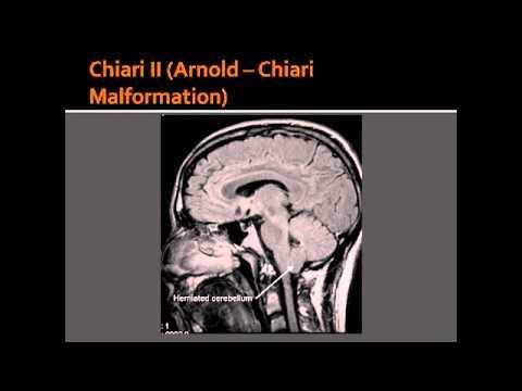 Ανωμαλία Chiari (Arnold Chiari): Η πρόπτωση (εγκολεασμός) των