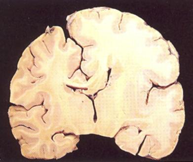 Εγκέφαλος >2 SD ΔΙΑΤΑΡΑΧΕΣ ΑΥΞΗΣΗΣ ΤΟΥ ΝΕΥΡΙΚΟΥ ΣΩΛΗΝΑ ΜΕΓΑΛΕΓΚΕΦΑΛΙΑ - ΗΜΙΜΕΓΑΛΕΓΚΕΦΑΛΙΑ Οστεοχονδροδυσπλασίες Σύνδρομα υπεραύξησης (Sotos) Μεταβολικά νοσήματα Ημιμεγαλεγκεφαλία: Νευροφακωματώσεις
