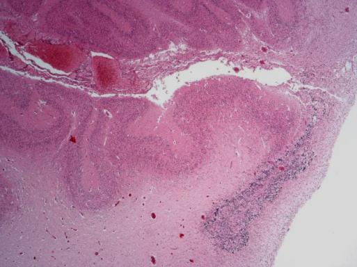 Συνύπαρξη άλλων νευροπαθολογοανατομικών βλαβών Εστίες πολυμικρογυρίας (διαταραχές του φλοιού) Νευρογλοιακές