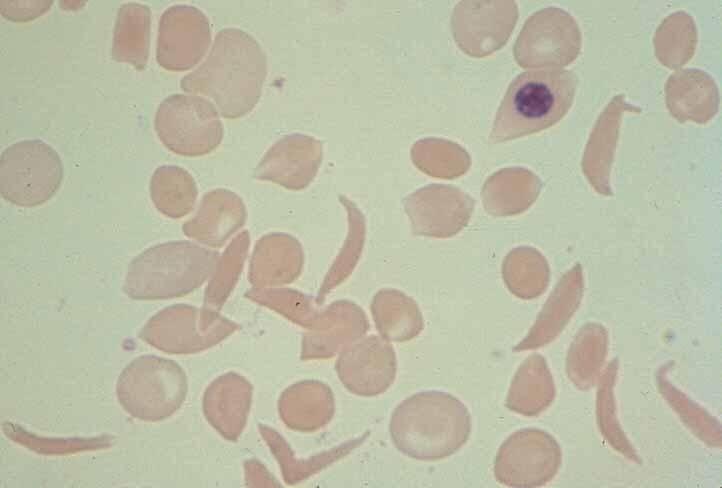 Δρεπανοκυτταρική νόσος: παθολογική HbS αυξημένη γλοιότητα/ μικροαγγειακές αποφράξεις.