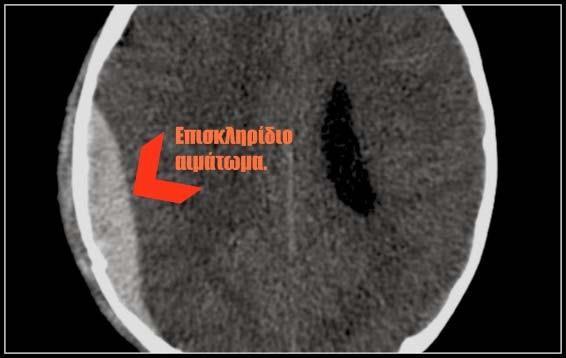 Όσον αφορά την αιμορραγία αυτή μπορεί να συμβεί σε τρεις περιοχές του εγκεφάλου, υποσκληρίδια αιμορραγία, επισκληρίδια αιμορραγία και αιμορραγία εντός του υπαραχνοειδούς και του ενδοκοιλιακού χώρου