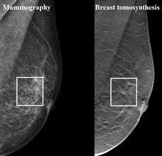 1-view DBT (MLO) ή 2-view DBT (MLO + CC) ή 1-view COMBINED = DBT MLO