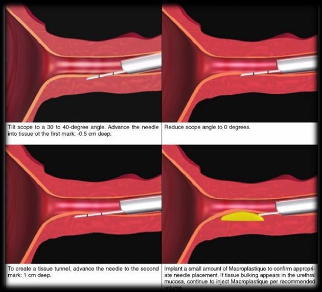 frozen urethra Early failure rate 50% Αποτυχία bulking agents δεν επηρεάζει την