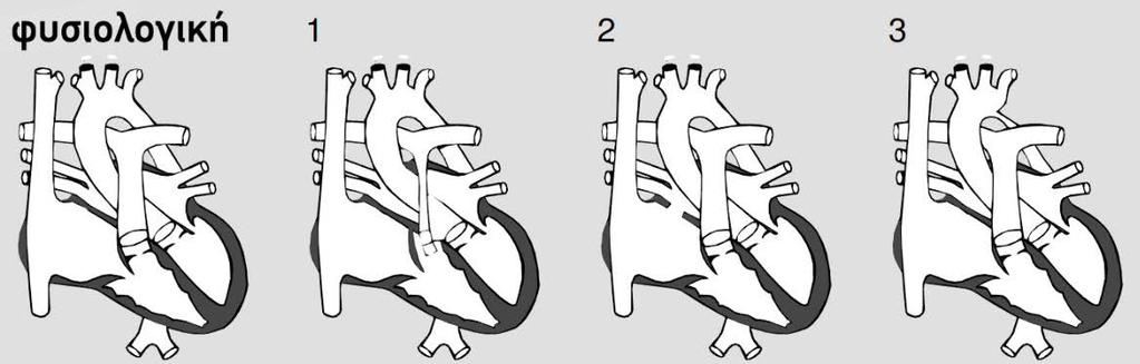 Στον τύπο 1, ο όγκος αίματος που ωθείται προς τους πνεύμονες είναι μικρότερος από τον φυσιολογικό. Β. Στον τύπο 2, αυξάνεται ο όγκος του παλμού της αριστερής κοιλίας. Γ.