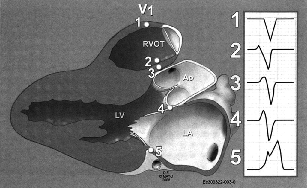 R στη V1