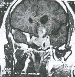 5 ng/ml, cabergoline 0.