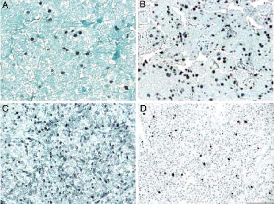 Προγνωστικοί παράγοντες κακοήθειας IHC Ki67 LI, p53 PRL adenoma Ki67 3% threshold for atypical adenomas GH-PRL tumor