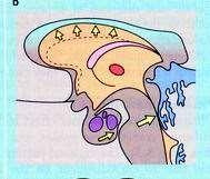 Ανάπτυξη υδροκέφαλου από