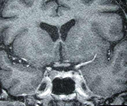 microadenoma