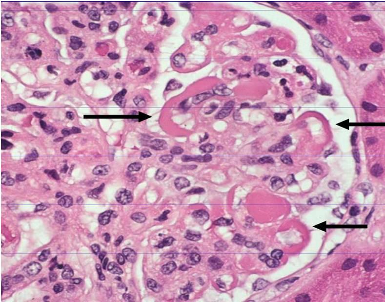 Membranoproliferative glomerulonephritis (MPGN) ΔΕΝ