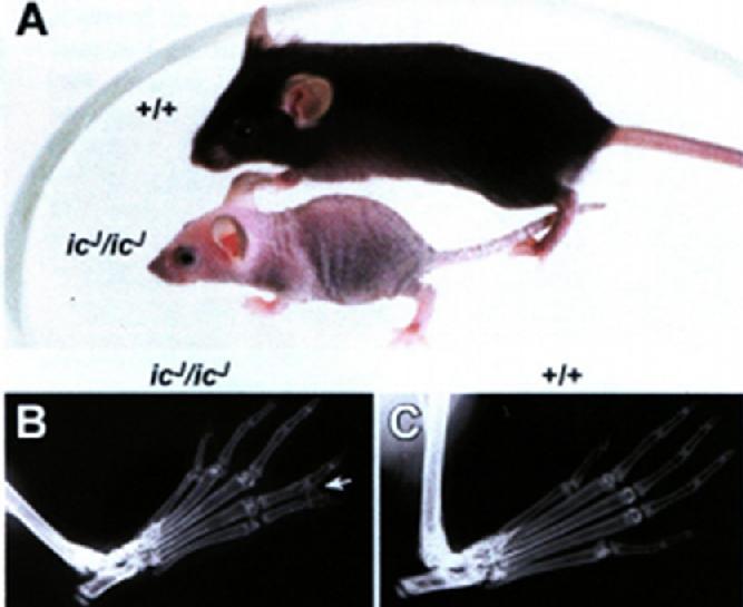 Διαταραχή Pelger-Huët που οφείλεται σε μεταλλάξεις μιας άλλης πρωτεΐνης της εσωτερικής πυρηνικής μεμβράνης, του υποδοχέα της λαμίνης Β (LBR) Μεταλλάξεις στο γενετικό τόπου ιχθύωσης (ichthyosis)