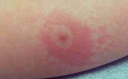 N. Lyme-γενικά Borrelia burgdorferi Ixodes scapularis (HΠA), ricinus, persulcatus (Eυρώπη) Mέσα άνοιξης εως και φθινόπωρο Εκτιμώμενη