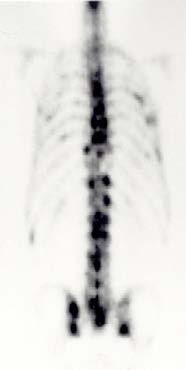 για εξέλιξη PSADT>12mo Time to BCR>3y GS<7 Stage<T3a Life