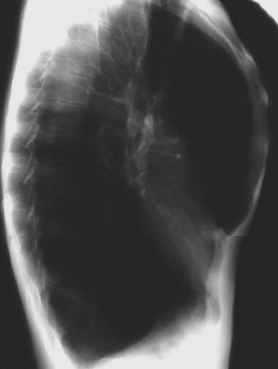 ημιδιαφράγματα Wright FW. Radiology of the Chest.