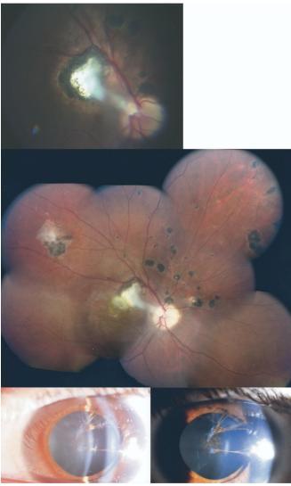 Longitudinal Study of New Eye Lesions in Children with Toxoplasmosis Who Were Not Treated